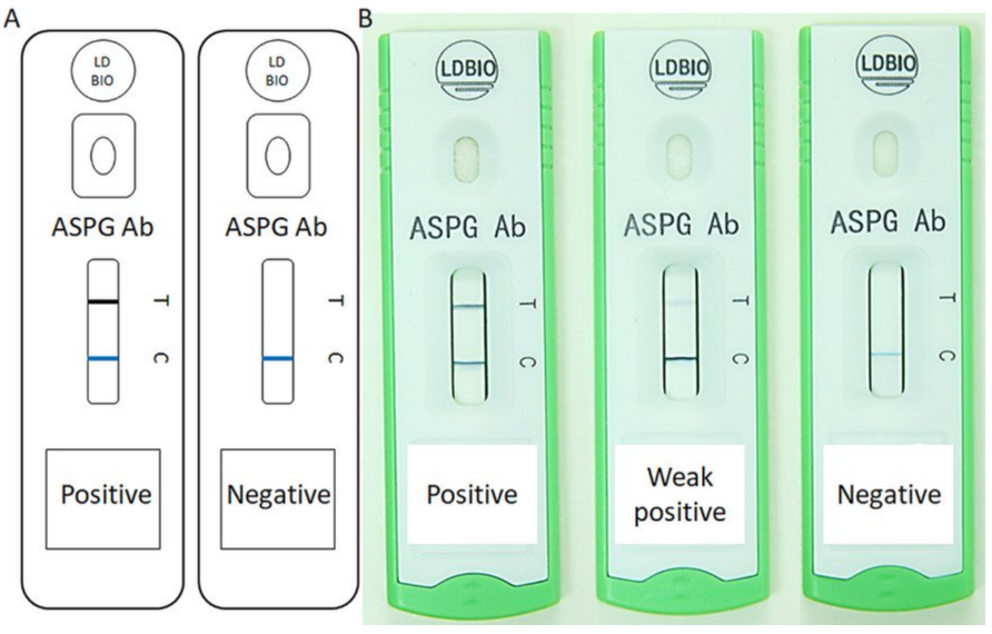 LDBio rapid Aspergillus IgG test sensitive and specific for CPA