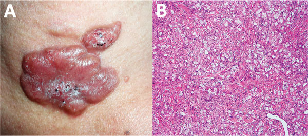 Lobomycosis lesions are typically nodular/keloid. Biopsy shows granulomatous inflammation with many yeast cells forming chains.