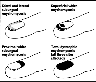 Tinea unguium effecting the toe nails. Diagnosis: Onychomycosis