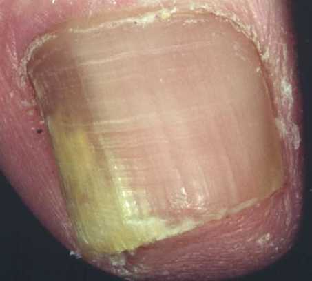 Aladdin Creations - 💥Onychomycosis, also known as tinea unguium, is a  fungal infection of the nail. 💥Symptoms may include white or yellow nail  discoloration, thickening of the nail, and separation of the