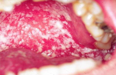 Recurrent oral thrush new arrivals