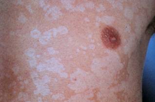 Foto de Medical: Tinea versicolor is a condition caused by the Malassezia  globosa fungus a form of yeasts. It is characterized by a skin discolor  eruption on the trunk and proximal extremities.