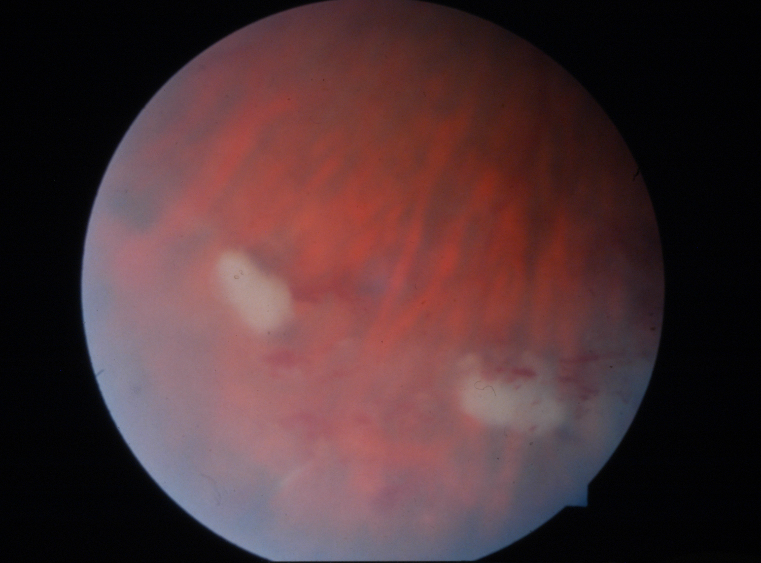 Fungal eye infections Life Worldwide