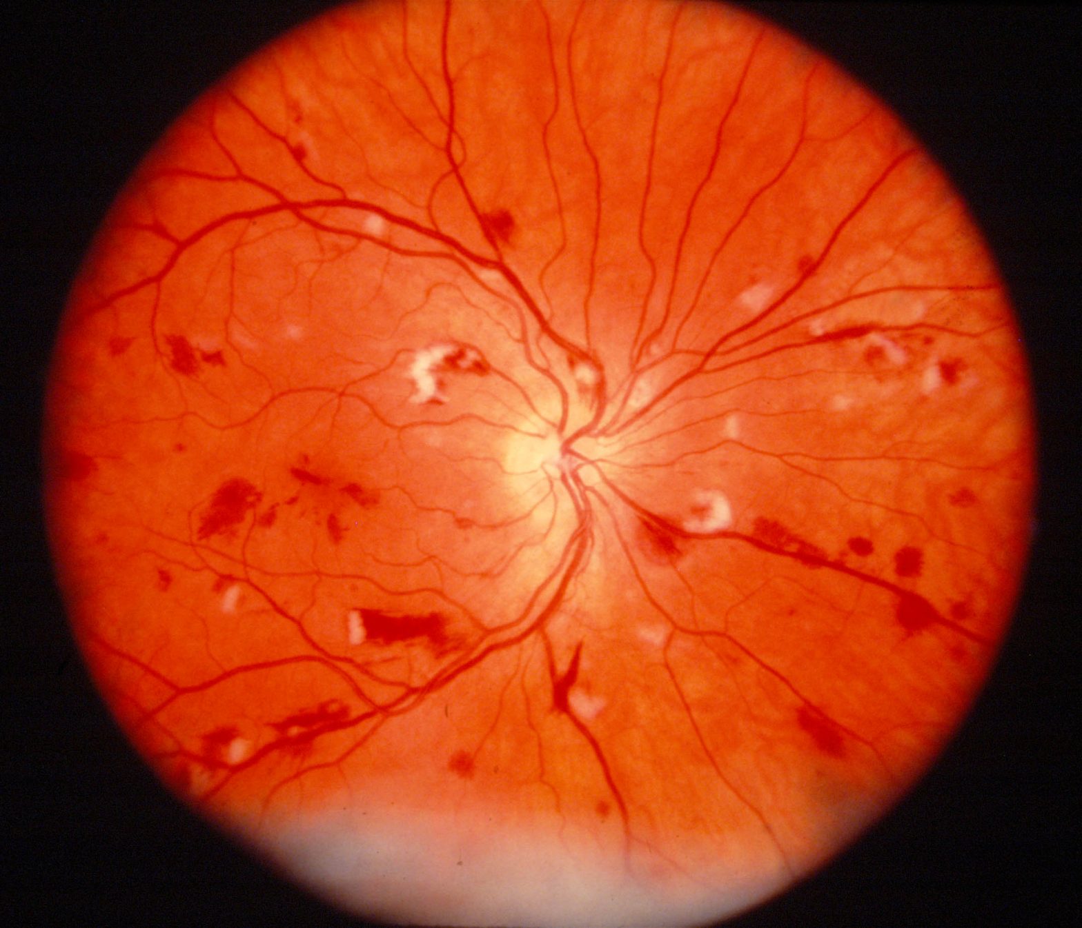 Fungal Eye Infections Life Worldwide