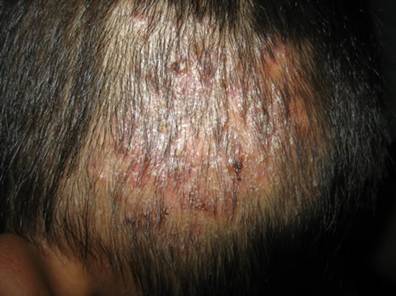 Tinea Capitis Infection - DoveMed