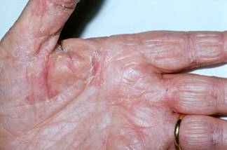 Fungal infection on a man's hand. Tinea manuum and close-up view