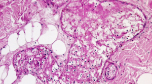 A slide showing mucormycosis