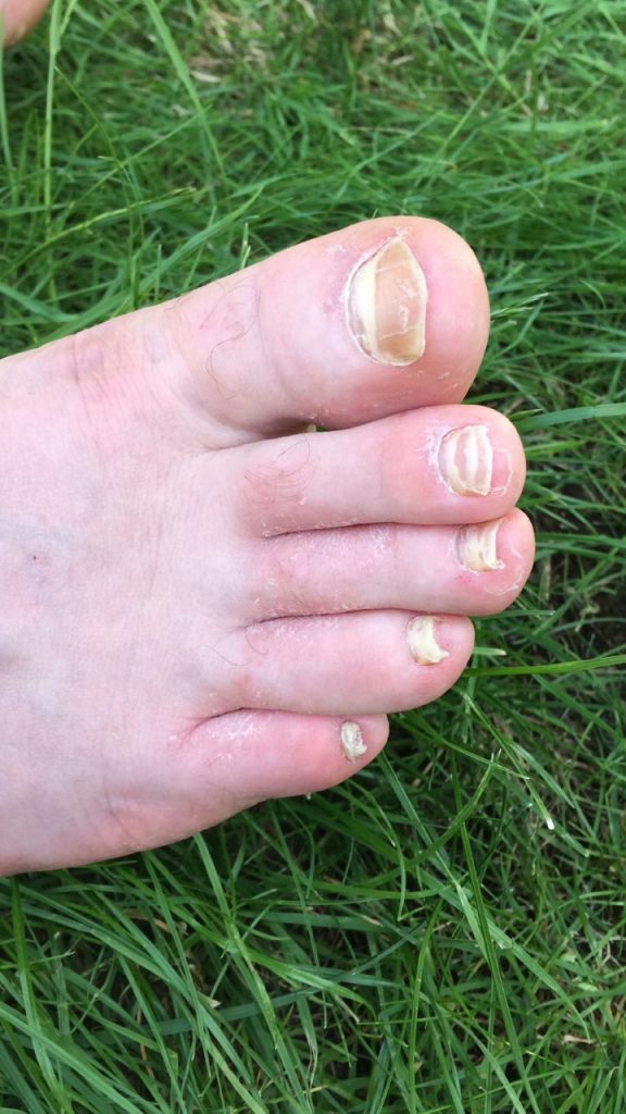 http://en.fungaleducation.org/wp-content/uploads/2021/06/thumbnail_Onychomycosis-3-1-576x1024.jpg