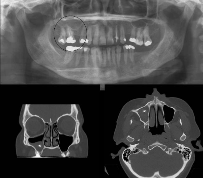 fungus in sinus cavity symptoms