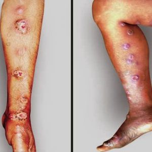 Patient with red lesions on leg
