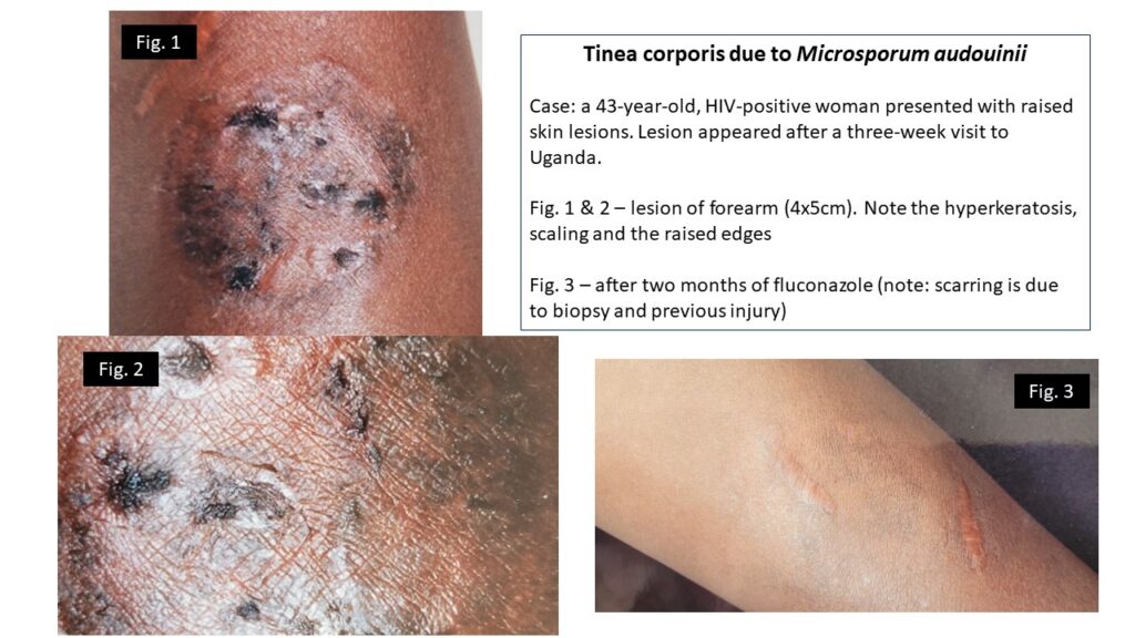 A. Extensive tinea nigra palmaris (case 1; Table 1); B. Localized