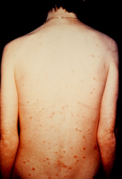 A drug user with disseminated candida rash.
